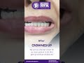 Smile enhancement