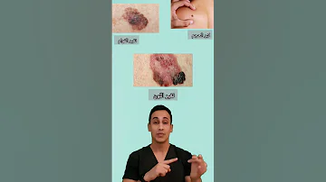 هل من الممكن تحول الشامات لسرطان جلد 