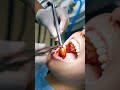 wisdom tooth extraction#dentist #doctor #dental #dentalclinic #wisdomtooth #teethdecay #surgeon