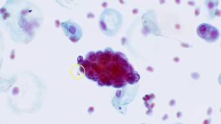 Cervical cytology  Endometrial cells