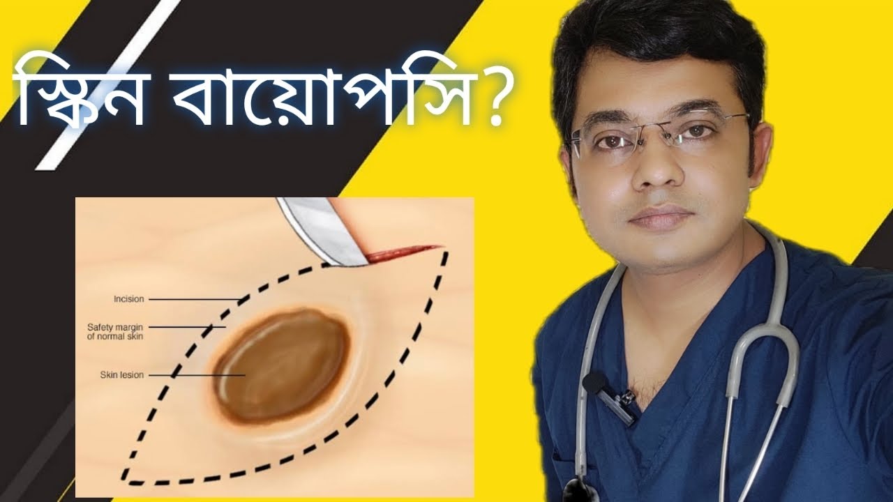 স্কিন বায়োপসি কেন করা হয়? Skin biopsy procedure doctorjoydeb YouTube