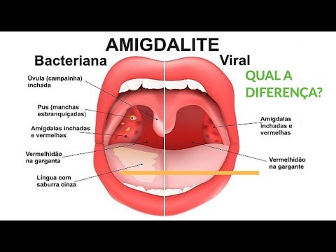 Amidalite ou amigdalite  Biblioteca Virtual em Saúde MS