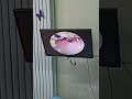 耳垢そうじ/耳が痒くなった鼓膜に付着した軟耳垢/062