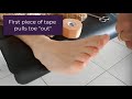 How To Hold A Curly Pinky Toe Straight With Tape