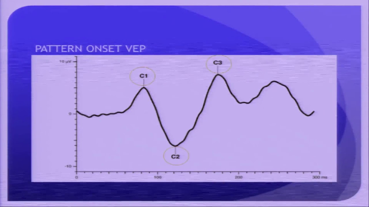 AIOC2018 - GP145 - Topic - Visually evoked potential : Clinical utility ...