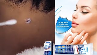 Instant Blemish Removal Gel - Sumifun Wart Remover