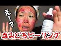 【血みどろピーリング】毛穴スッキリ⁉The Ordinary | AHA30% + BHA2% ピーリングソリューションでツルツル肌になったｗｗ【使い方】