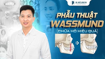 Phẫu thuật Wassmund chữa hô hiệu quả (Phẫu thuật hàm hô có nhổ 4 răng 4)