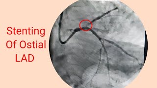 Heart attack (AWMI) lI Stenting of Ostial LAD