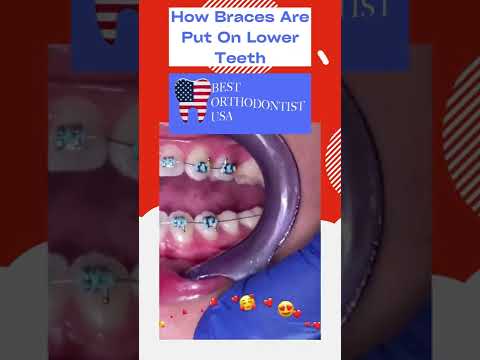 How Braces Are Put On Lower Teeth #Shorts #braces