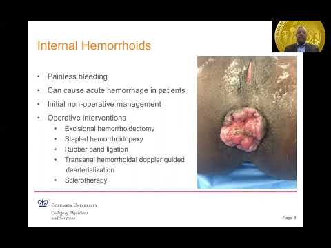 Rectal Bleeding From Anorectal Sources Did I Mention He Is On Coumadin 