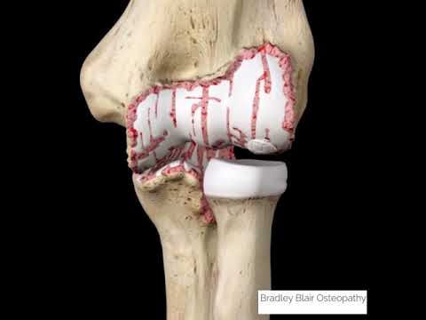 Wideo: Gdzie znajduje się chrząstka w stawie łokciowym?