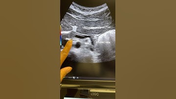 How to image the pancreas via ultrasound! #ultrasound #pancreas #sonography