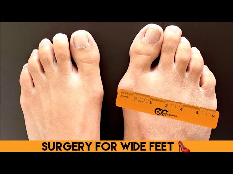 SURGERY FOR WIDE FEET? WAIT UNTIL YOU SEE THIS !!! (BEFORE & AFTER  TRANSFORMATION) 