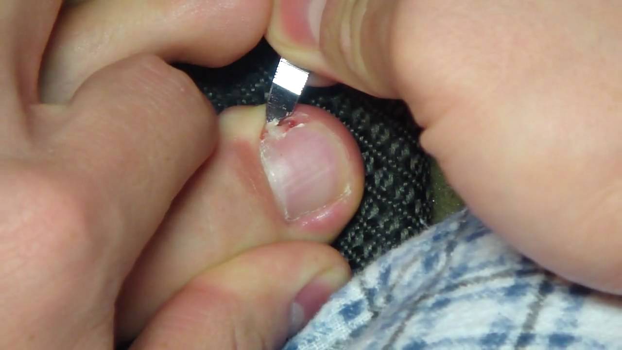 2nd attempt at removing ingrown toenail YouTube