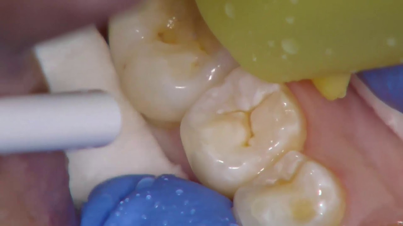 Clinical Demonstration Of Resin Fissure Sealant Placement On Tooth 45 