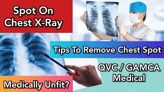 QVC Medical |💥How To Remove Chest X-Ray Spot| Part-2 screenshot 3
