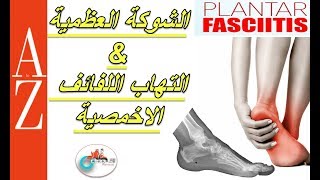 Plantar Fasciitis |From A to Z| الشوكة العظمية | التهاب اللفائف الاخمصية | الاسباب والعلاج والجراحة