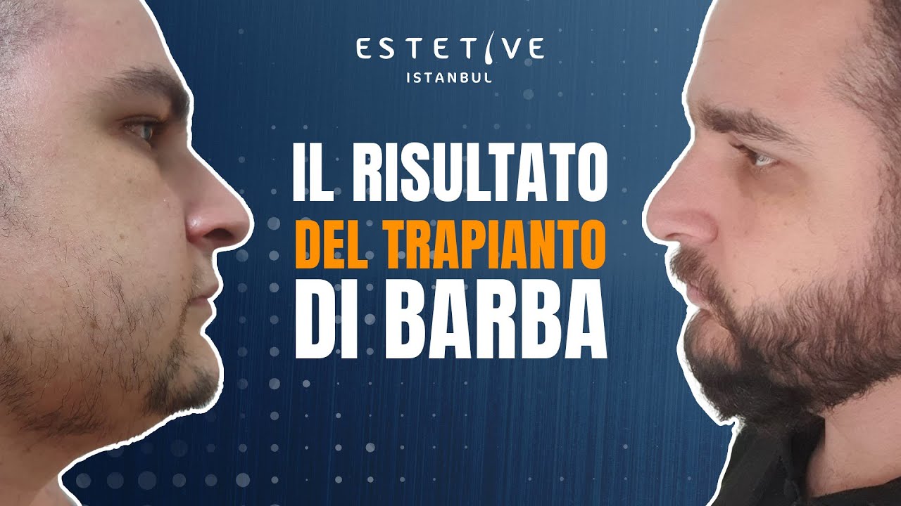 IL RISULTATO DEL TRAPIANTO DI BARBA