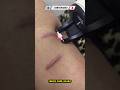 Laser Treatment For Scars Bruises Wounds Skin Healing And Renewal Results mp3