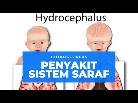 Penyakit Hidrosefalus