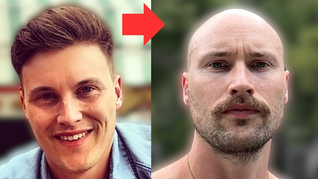 Should I Have Taken Finasteride/Minoxidil?