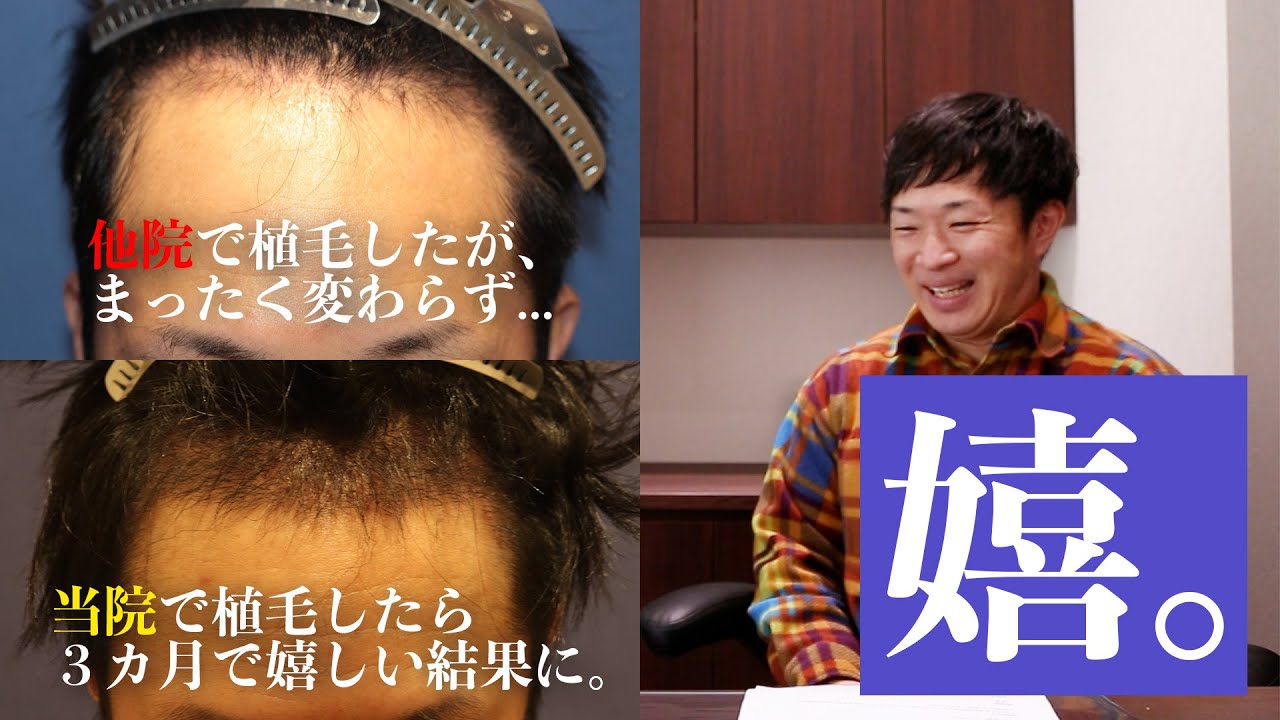 植毛3ヶ月後 生え始め】実際に自毛植毛を受けられた体験者様にお話を