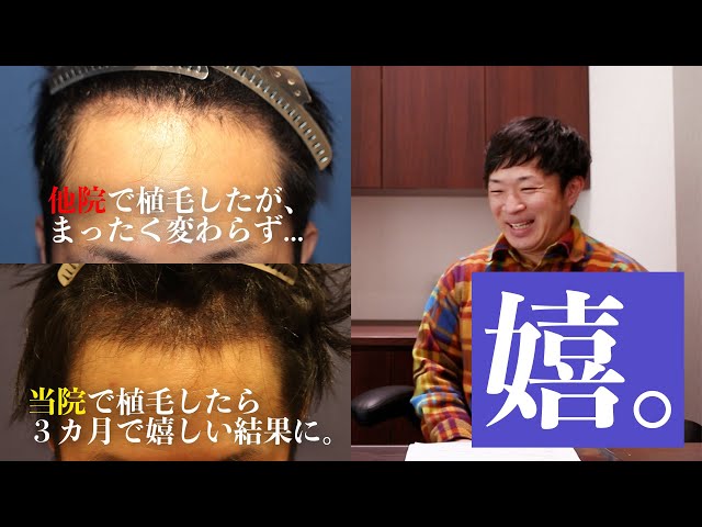 植毛3ヶ月後 生え始め】実際に自毛植毛を受けられた体験者様にお話を