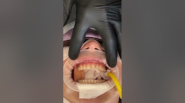 Porcelain Veneer Delivery from Start to Finish - Inside the Process