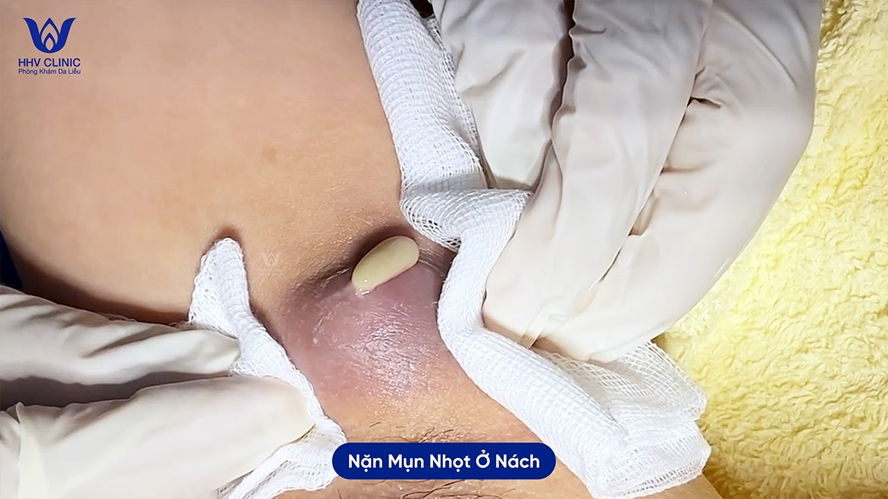 Nặn ổ áp xe chai cứng lâu năm cái kết không ngờ.