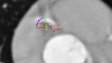 Markup interaction - translation and rotation - in Slicer 3D on the example Slicer 3D data