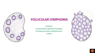 FOLLICULAR LYMPHOMA - PATHOGENESIS, MORPHOLOGY AND PROGNOSTIC FACTORS -  DR.V. SHANTHI