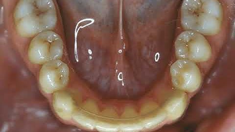 Video of Tooth Movement