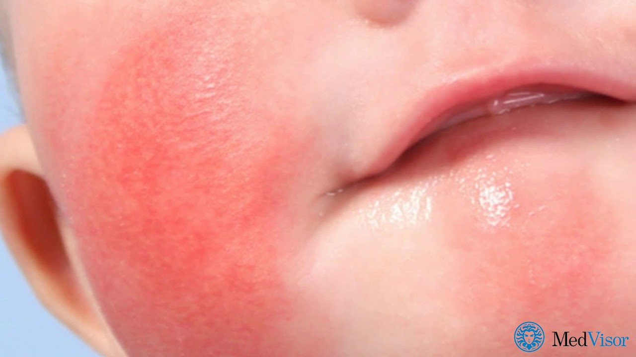 Диатез от сладостей у детей: его причины и симптомы