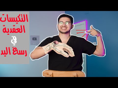 علاج التكيسات العقدية في رسغ اليد تكيسات اليد   