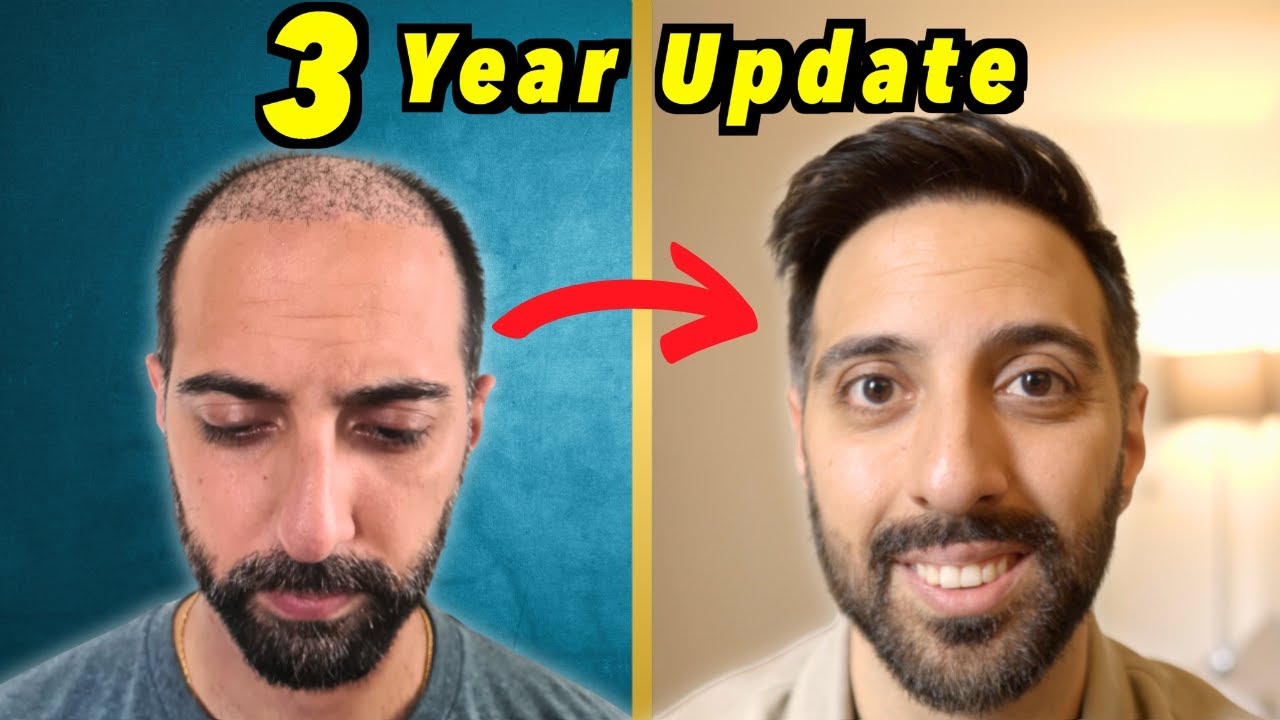 3 YEAR Hair Transplant Update from Turkey | 6100 GRAFTS FUE | 
