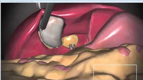 Hierarchical Examination of Colliding Points Between Rigid and Deformable Objects