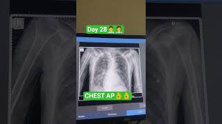 ##CHEST AP VIEW##Radiographer##Radiology department##x-ray##Ct-scan##MRI#👌👌