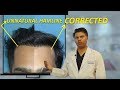 Unnatural Hairline in Hair Transplant and Aesthetics| @Eugenix Hair Sciences By- Dr. Pradeep Sethi