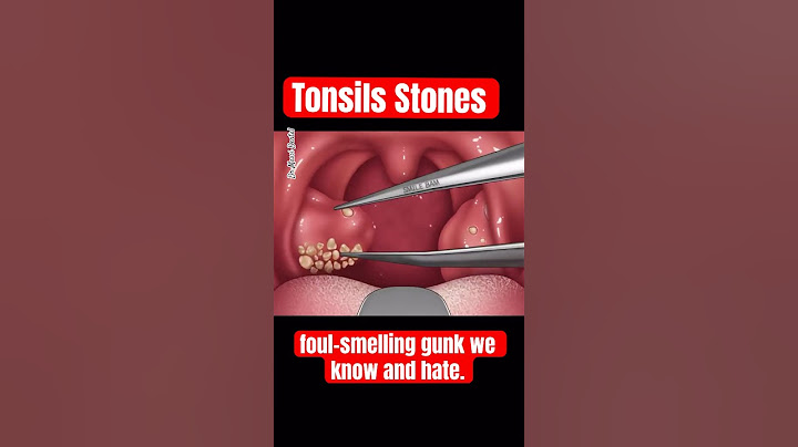 TONSILS STONES, TONSILLITIS