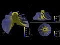 Thermal analysis of a centrifugal impeller (cooldown step)