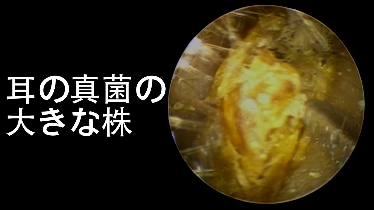 Relaxing Earwax Removal big stock of fungus in ear YouTube