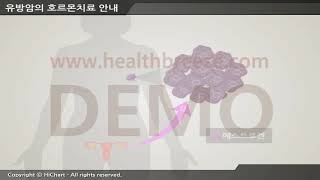 [시연용]c0144aako_[축약판]유방암의 호르몬치료 안내