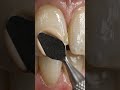 Minor Broken Edge Tooth – Before & After Bonding Repair 😱