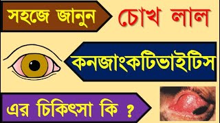 Conjunctivitis: causes and treatment of conjunctivitis have been discussed in Bengali.