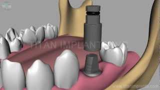 Famous How to place and Restore Titan TG Post Abutment Wealth