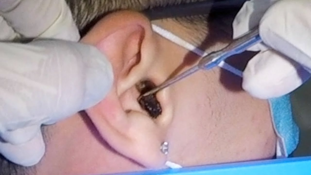 How to Remove A Massive Earwax Stuck in Man's Ear YouTube