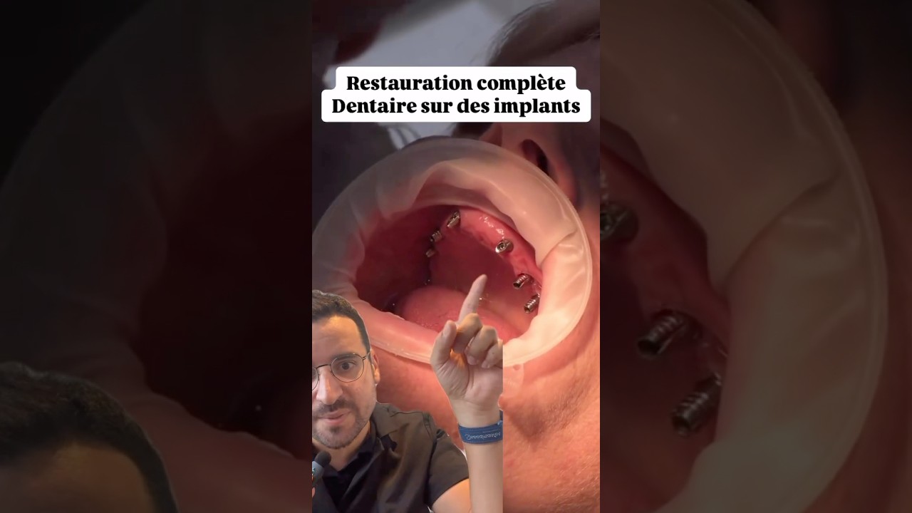 Implants dentaires : Que se passe-t-il entre la vis et la dent ?