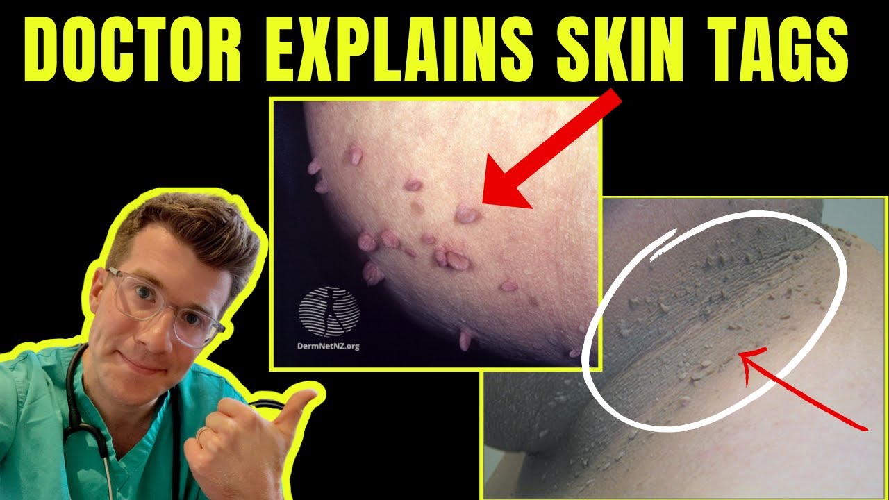 Doctor explains SKIN TAGS - including CLINICAL PHOTOS, CAUSES & TREATMENT