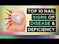 10 NAIL SIGNS of HEALTH PROBLEMS (and Nutritional Deficiencies)